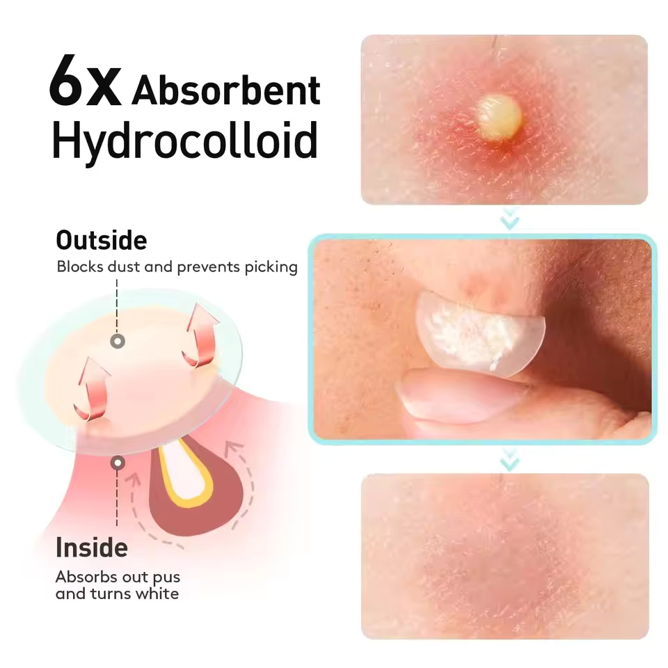 360 adet/kutu akne bantları -  - Essential Oils incelemesi ve fiyatı